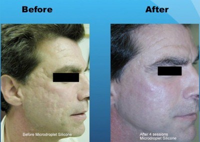 Acne Scar Revision - Skin acne scar treatment