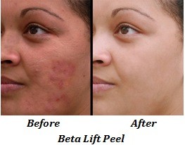 Beta Lift Peel (before and after)
