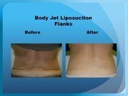 Body Jet Liposuction Flanks