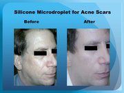 Silicone Microdroplet for Acne Scars