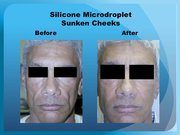Silicone Microdroplet Sunken Cheeks