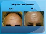 Surgical Line Removal