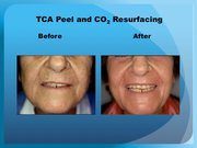 TCA Peel and CO2 Resurfacing
