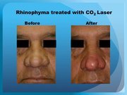 Rhinophyma treated with CO2 Laser