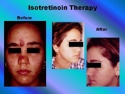 Isotretinoin Therapy