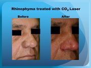 Rhinophyma treated with CO2 Laser