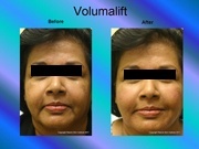 Volumalift Charran Full Face