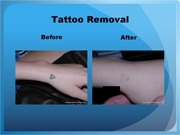 Tattoo Removal