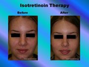 Isotretinoin Therapy