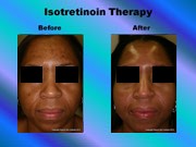 Isotretinoin Therapy