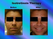 Isotretinoin Therapy