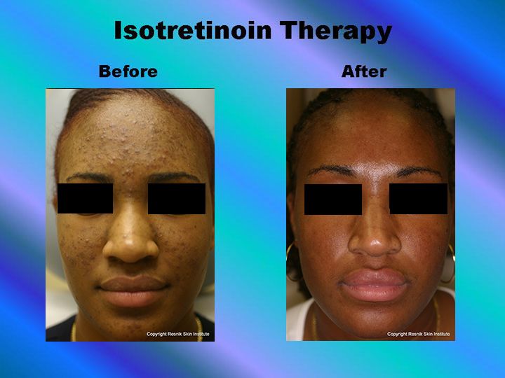 Isotretinoin Therapy