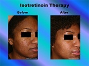 Isotretinoin Therapy