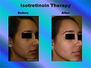 Isotretinoin Therapy