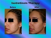 Isotretinoin Therapy