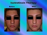 Isotretinoin Therapy