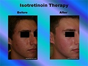 Isotretinoin Therapy