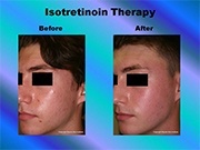 Isotretinoin Therapy