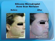 Silicone Microdroplet Acne Scar Revision