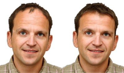 Hair Transplantation - Hair restoration