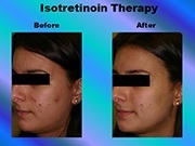 Isotretinoin Therapy