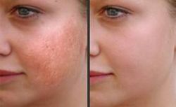 Laser Skin Resurfacing - Cosmetic laser skin surgery