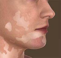 Permanent Depigmentation for Vitiligo