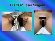 HS CO2 Laser Surgery