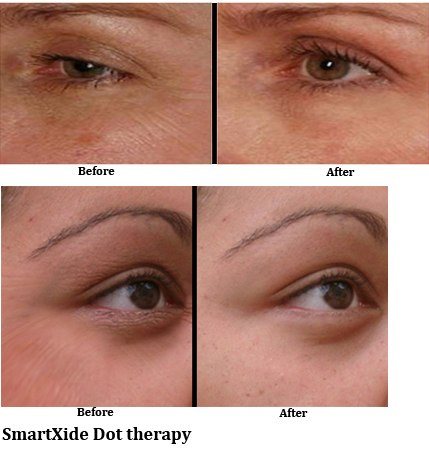 SmartXide Dot: Facial Resurfacing