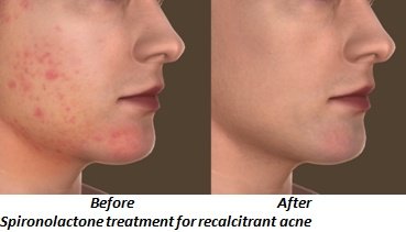 Spironolactone Therapy for Recalcitrant Acne
