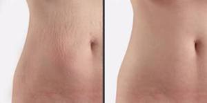 Laser Treatment for Stretch Marks