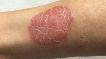 Treatment of psoriasis with injected cortisone