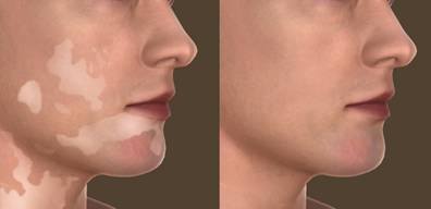 Vitiligo Minigraft Surgery (before and after treatment) 